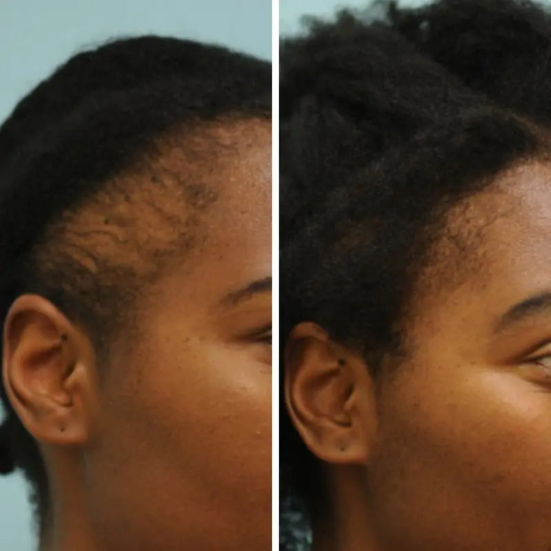 AEXZR™ Natural Hair Growth Serum - 🔥🔥Revive Your Natural Hair in 2 Weeks!🔥🔥