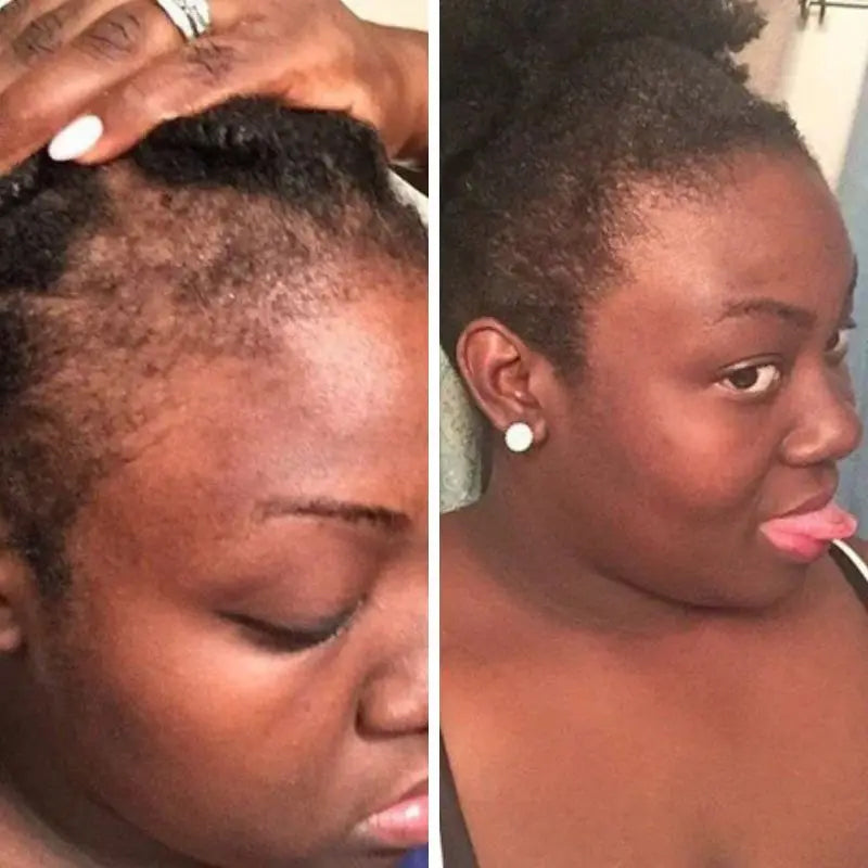 AEXZR™ Natural Hair Growth Serum - 🔥🔥Revive Your Natural Hair in 2 Weeks!🔥🔥