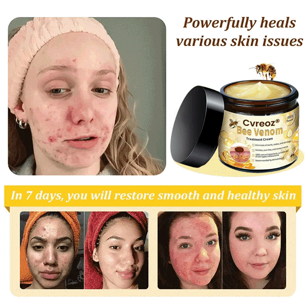 🌟 Last 14Pcs Left | Cvreoz® Bee Venom Skin Treatment Cream