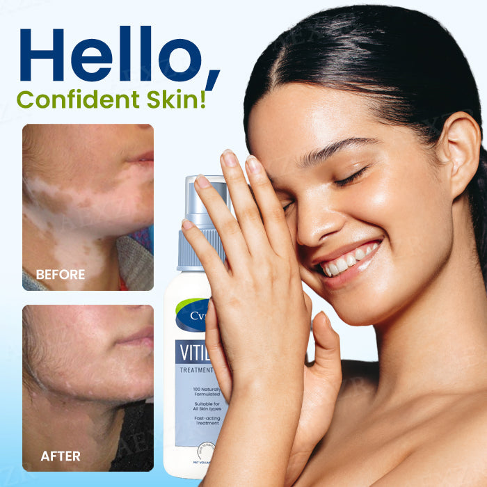 🔥Hot Sales - 50% OFF🔥Cvreoz® Vitiligo Treatment Spray