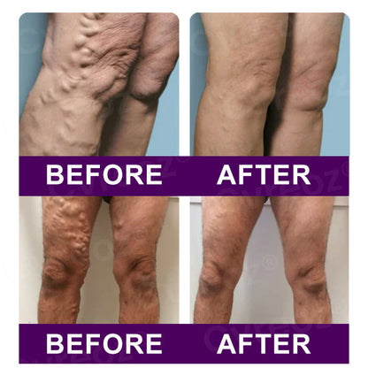 🔥Hot Sales - 50% OFF🌿Cvreoz® Polidocanol Nano Patches for Varicose Veins