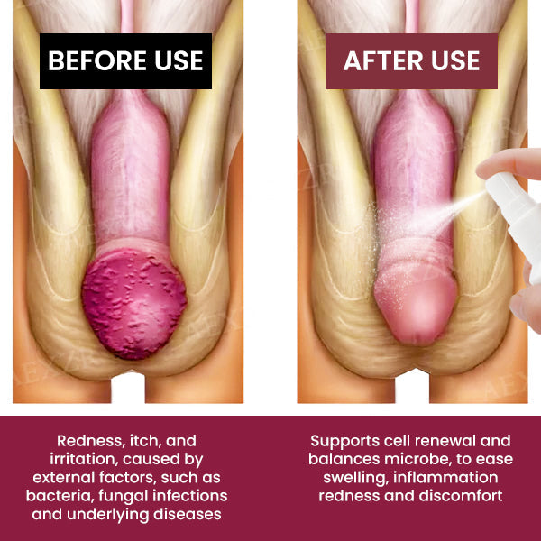 Protua™ Balanitis Treatment Spray - 👩‍⚕️Expert Recommendations Backed by the Health Association in the USA!🔥