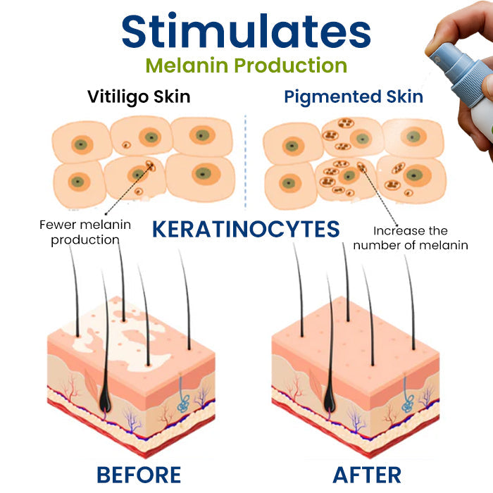 🔥Hot Sales - 50% OFF🔥Cvreoz® Vitiligo Treatment Spray