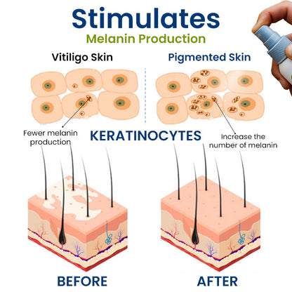 🔥Hot Sales - 50% OFF🔥Cvreoz® Vitiligo Treatment Spray