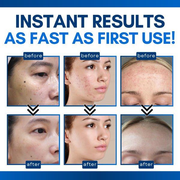 Official Store | Bikenda® Skin Tag Treatment Pen✅Just once a week, visible changes in 7 days🔥