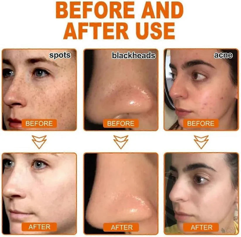 AEXZR® ✅ 𝕤𝕒𝕧𝕖 𝕦𝕡 𝕥𝕠 𝟟𝟘% Whitening and Freckle - Removing Mask