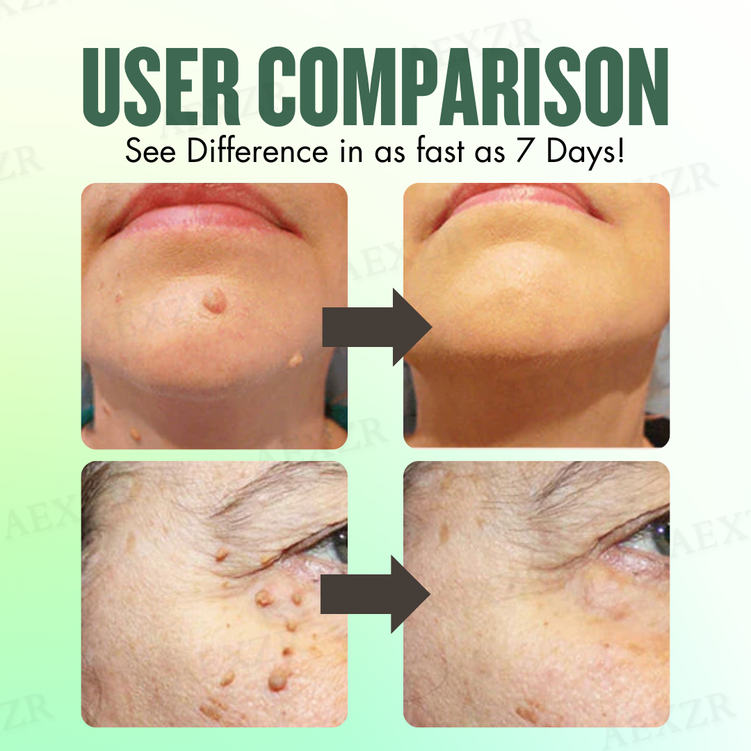 Dermazi™ -🆂🅰🆅🅴 🆄🅿 🆃🅾 8️⃣0️⃣% 🆃🅾🅳🅰🆈-  Instant Blemish Removal Cream