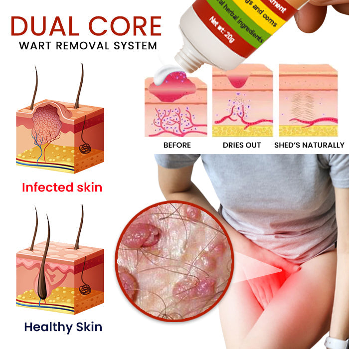 19 Pieces LEFT!!.. Cvreoz® FemGenital Wart Remover Cream ✅ 70% Off! Ends in 10 Minutes!