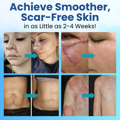 🌟 Official Store |🔥LAST 22 PCS LEFT |🔥Hot Sale - 50% OFF🌿Cvreoz® Scar Vanquisher Aqua Gel