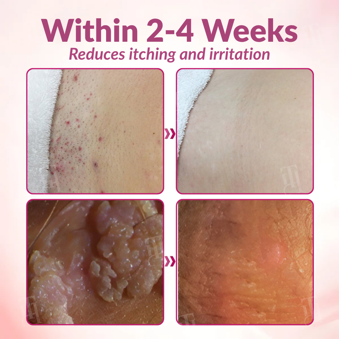 🌟 Official Store | Piguiay® Femina HPV Relief Capsules – Unlock Comfort and Confidence!