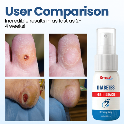 🔥Hot Sales - 50% OFF🔥Cvreoz® Diabetes Foot Guard Recovery Spray
