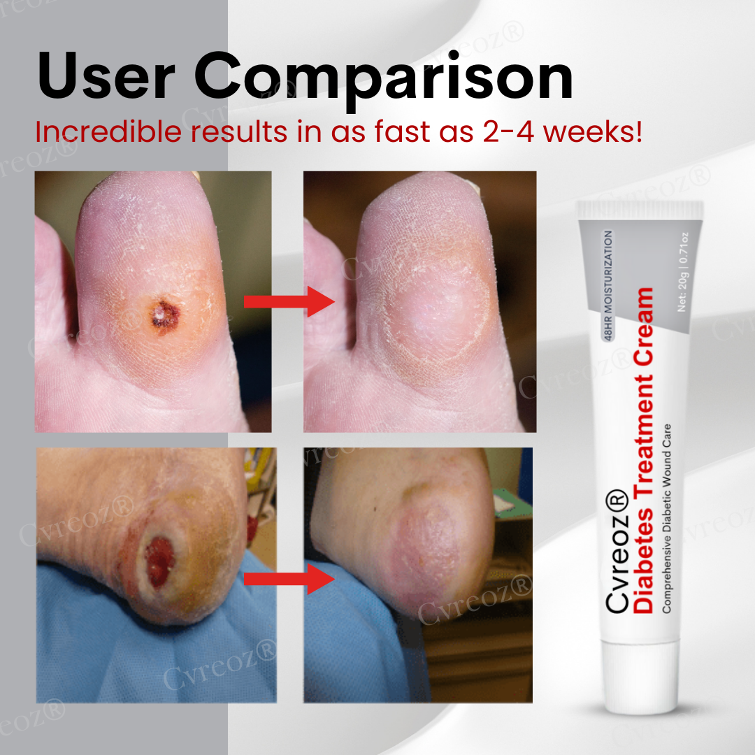 Cvreoz® Diabetes Treatment Cream