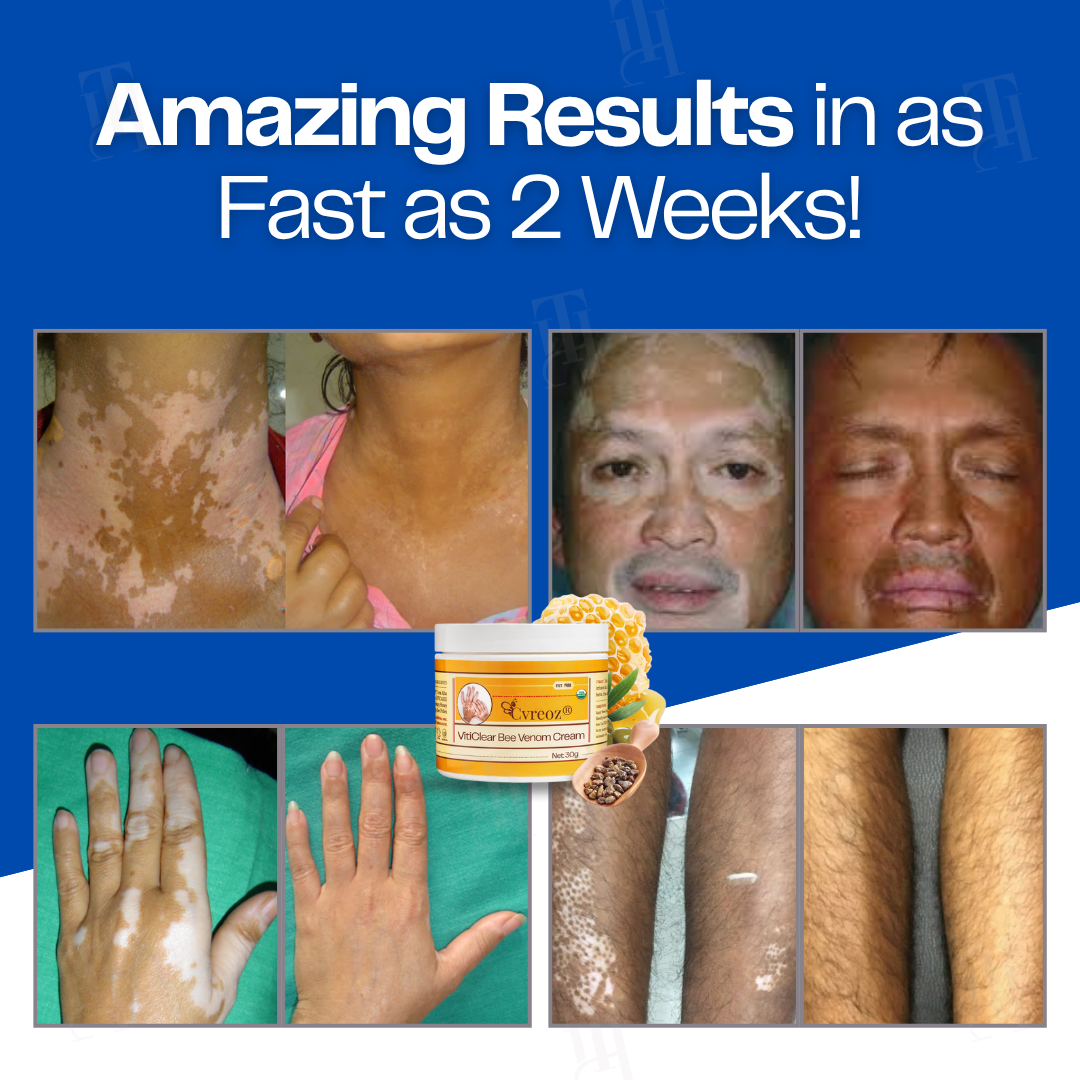 🔥Hot Sales - 50% OFF🐝Cvreoz® VitiClear Bee Venom Cream