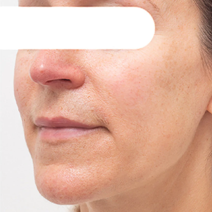 AEXZR® Herbal Spots ✅ 𝕤𝕒𝕧𝕖 𝕦𝕡 𝕥𝕠 𝟟𝟘% Peel-Off Facial Mask
