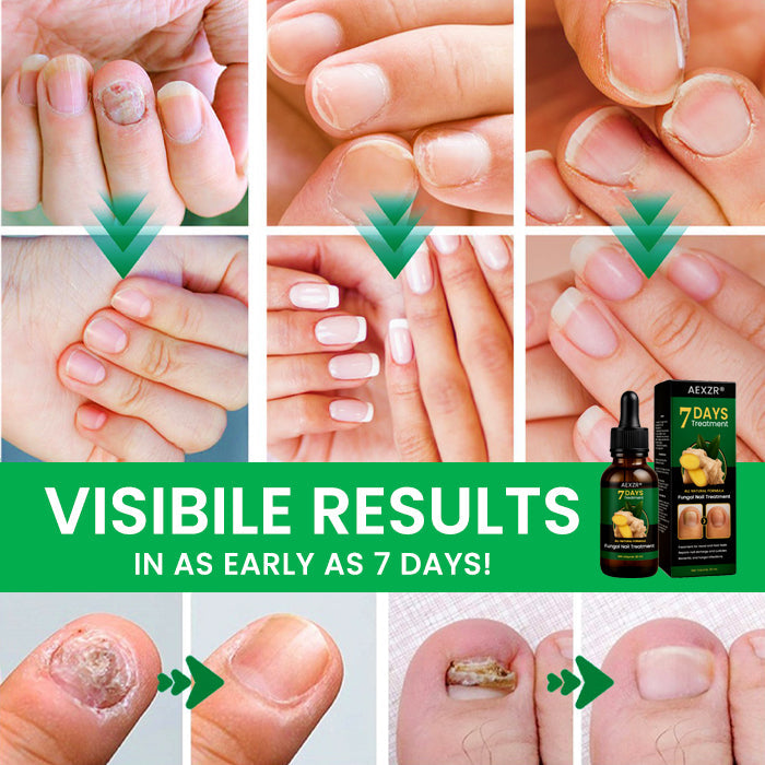 🔥 Official Store | AEXZR® Fungal Nail Treatment✅ Say Goodbye to Fungal Infections and Hello to Healthy Nails!
