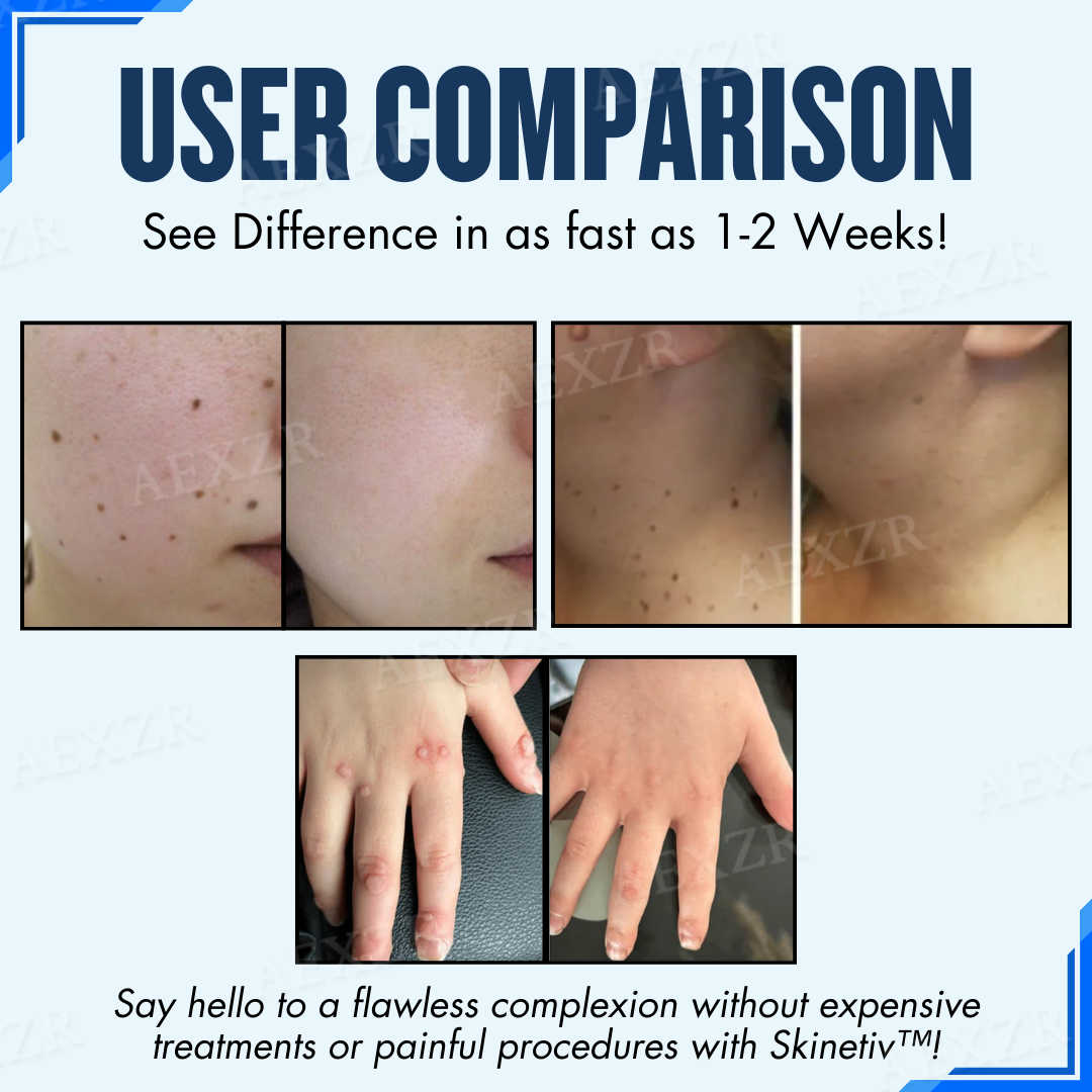 Skinetiv™ -🆂🅰🆅🅴 🆄🅿 🆃🅾 80% 🅾🅵🅵- Moles & Warts Removing Skin Tag Patch