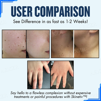 Skinetiv™ -🆂🅰🆅🅴 🆄🅿 🆃🅾 80% 🅾🅵🅵- Moles & Warts Removing Skin Tag Patch