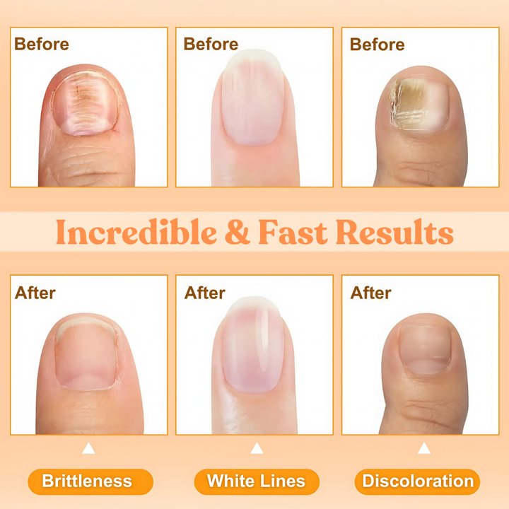 🔥Hot Sales - 50% OFF🔥AEXZR® Bee Venom Nail Repair Treatment Spray