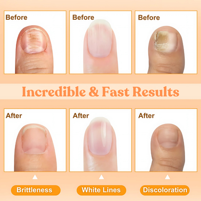 🔥Hot Sales - 50% OFF🔥AEXZR® Bee Venom Nail Repair Treatment Spray