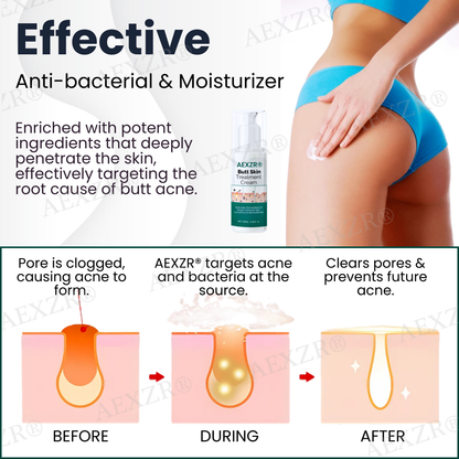 🌟 Official Store | AEXZR® Butt Skin Treatment Cream💕 Say Goodbye to Bumps and Hello to Smooth, Radiant Skin!