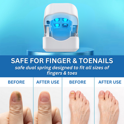 🔥Hot Sales - 50% OFF🔥Bikenda® Nail Fungus Laser Treatment Device